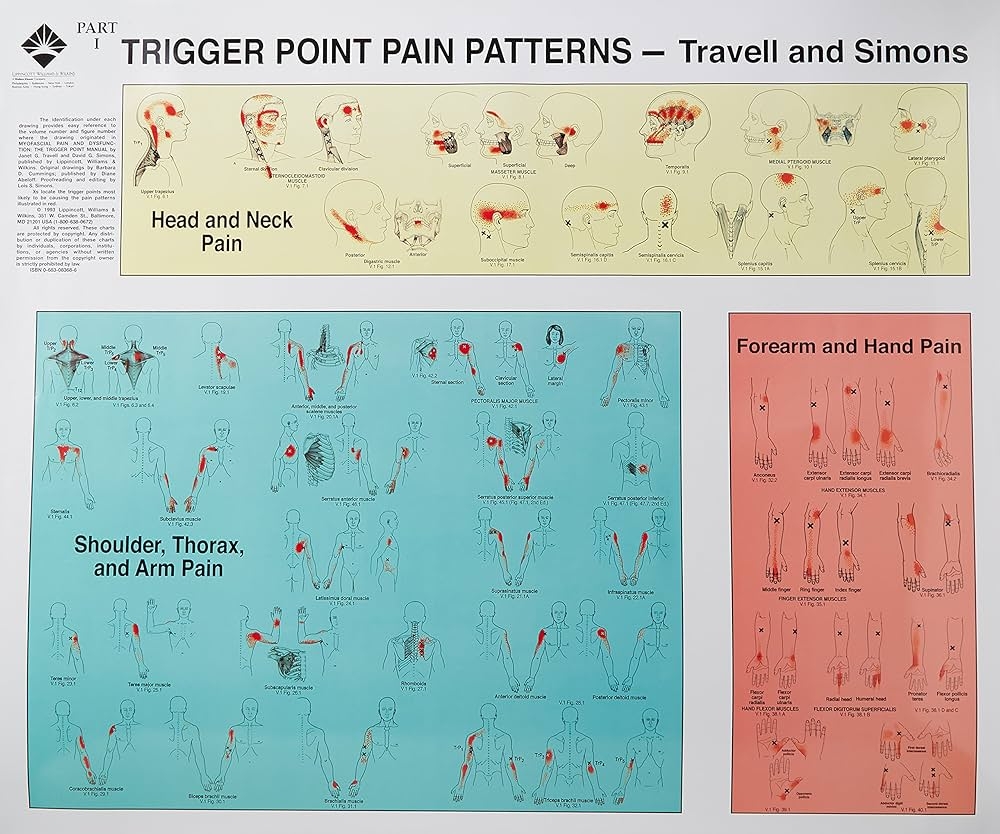 Trigger Points Chart 2 Parts Soft Lamination Prime Trigger Points Chart TP1L 85 00 Prime Alternatives Massage Tables Australia